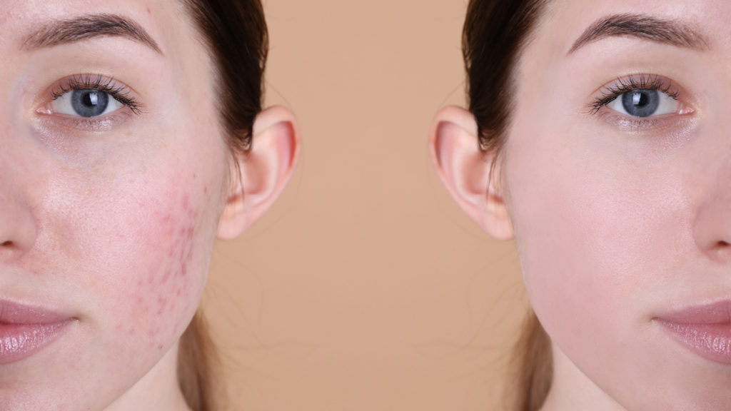 Comparaison avant et après d'un visage féminin. La moitié gauche montre une peau présentant des rougeurs et des imperfections liées à l'acné, tandis que la moitié droite révèle une peau lisse et uniforme, sans imperfections visibles.
